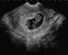 ultrasound-9week-preg1.gif